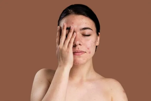  Why Acne Behaves Differently in Adults vs Teenagers