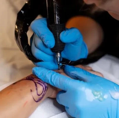 Laser Tattoo Removal: Frequently Googled Questions