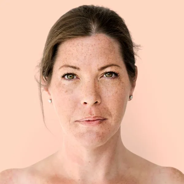  Melasma Explained: Why It Recurs & How Dermatologists Control It