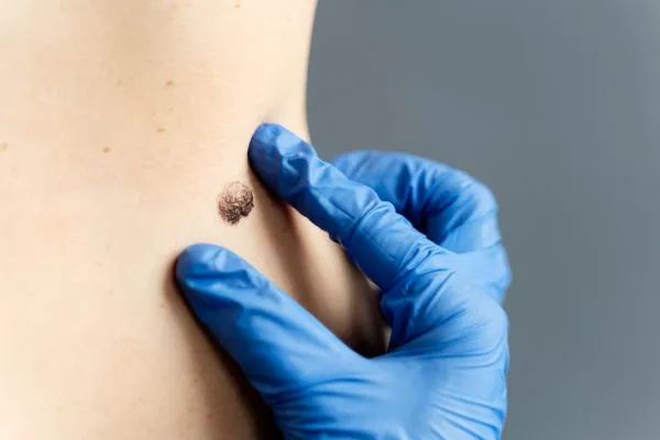 Mole & DPN Removal: Safe & Popular Solutions