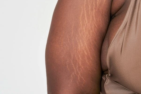 Stretch Marks: Why Creams Fail & Lasers Work