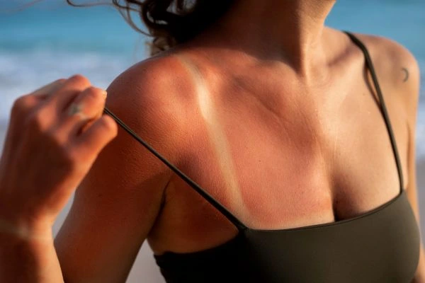 Tanning vs Pigmentation: How Dermatologists Tell the Difference