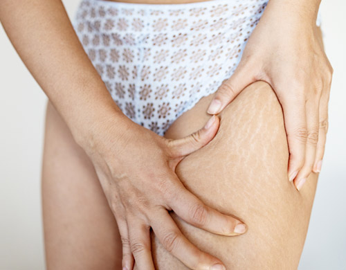 Stretch Marks Reduction