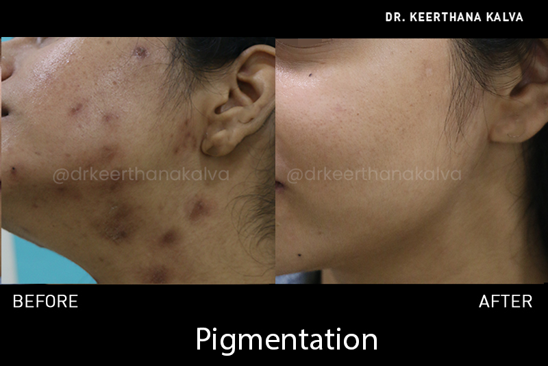 Pigmentation Treatment