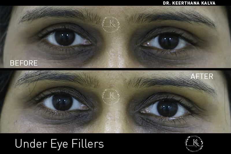 Under Eye Fillers Treatment